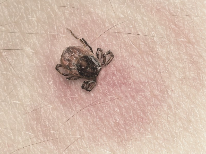 tick buried in skin